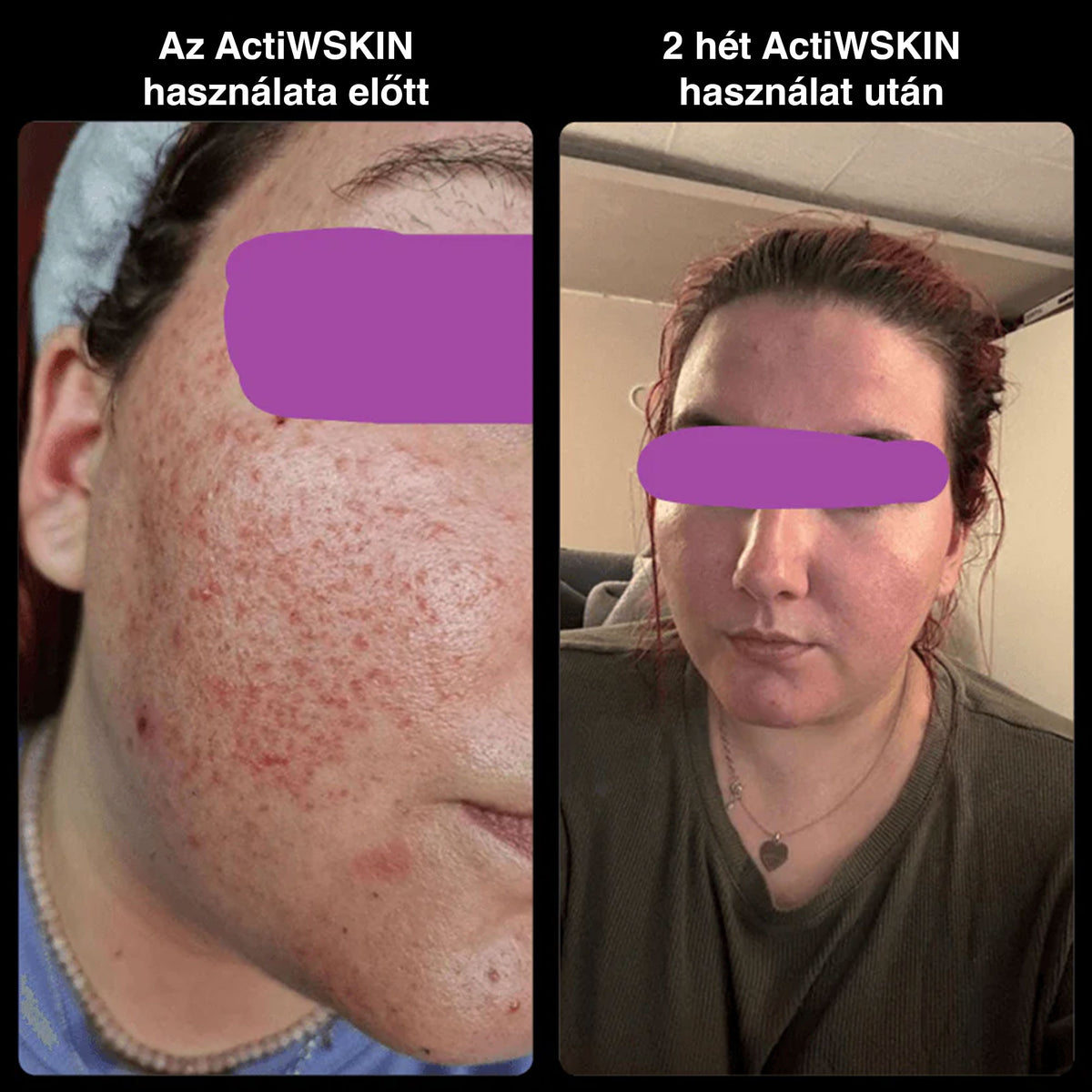 ActiW SKIN – AKNE ELLEN – Nagy csomag (21–25 nap)