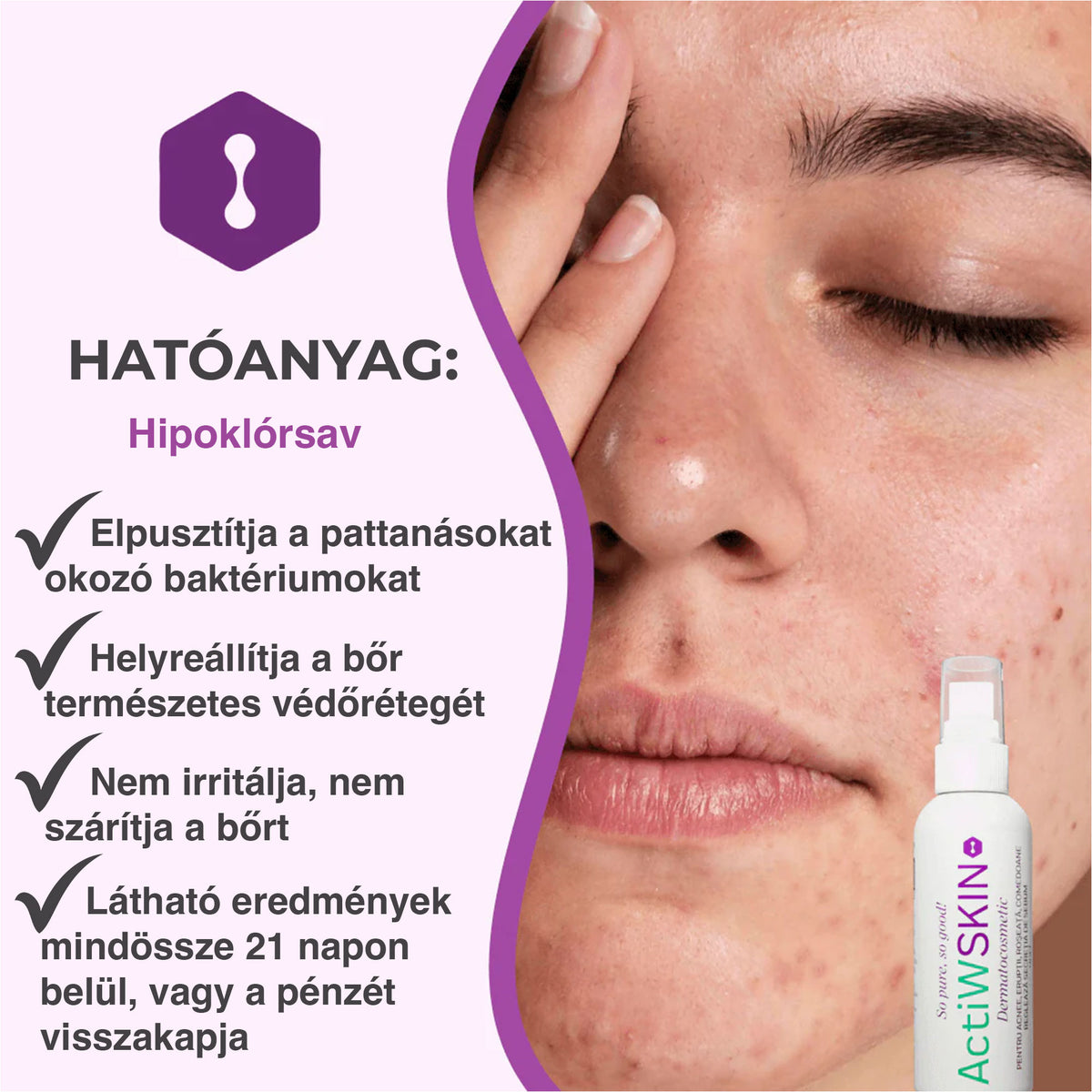 ActiW SKIN – AKNE ELLEN – Teljes csomag (12–15 nap)