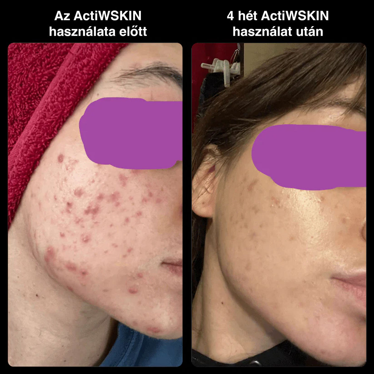 ActiW SKIN – AKNE ELLEN – Teljes csomag (12–15 nap)