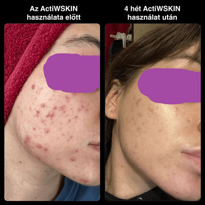 ActiW SKIN – AKNE ELLEN – Teljes csomag (12–15 nap)