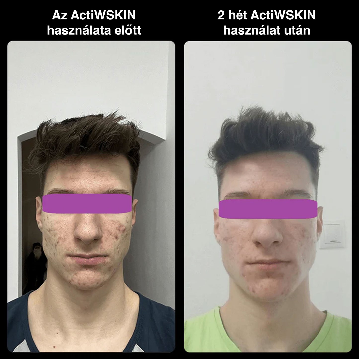 ActiW SKIN – AKNE ELLEN – Teljes csomag (12–15 nap)