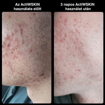 ActiW SKIN – AKNE ELLEN – Teljes csomag (12–15 nap)