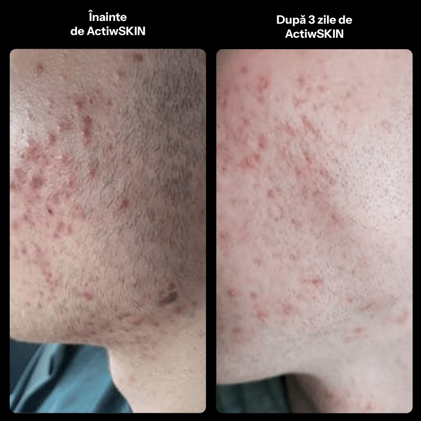 ActiW SKIN - PENTRU ACNEE - Pachet mic - Tratament 12-15 zile