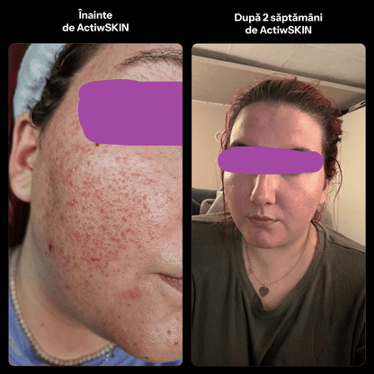 ActiW SKIN - PENTRU ACNEE - Pachet mic - Tratament 12-15 zile
