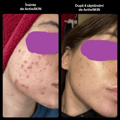 ActiW SKIN - PENTRU ACNEE - Pachet mic - Tratament 12-15 zile