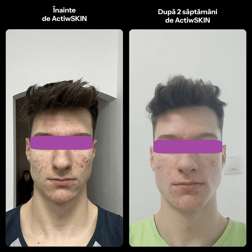 ActiW SKIN - PENTRU ACNEE - Pachet mic - Tratament 12-15 zile